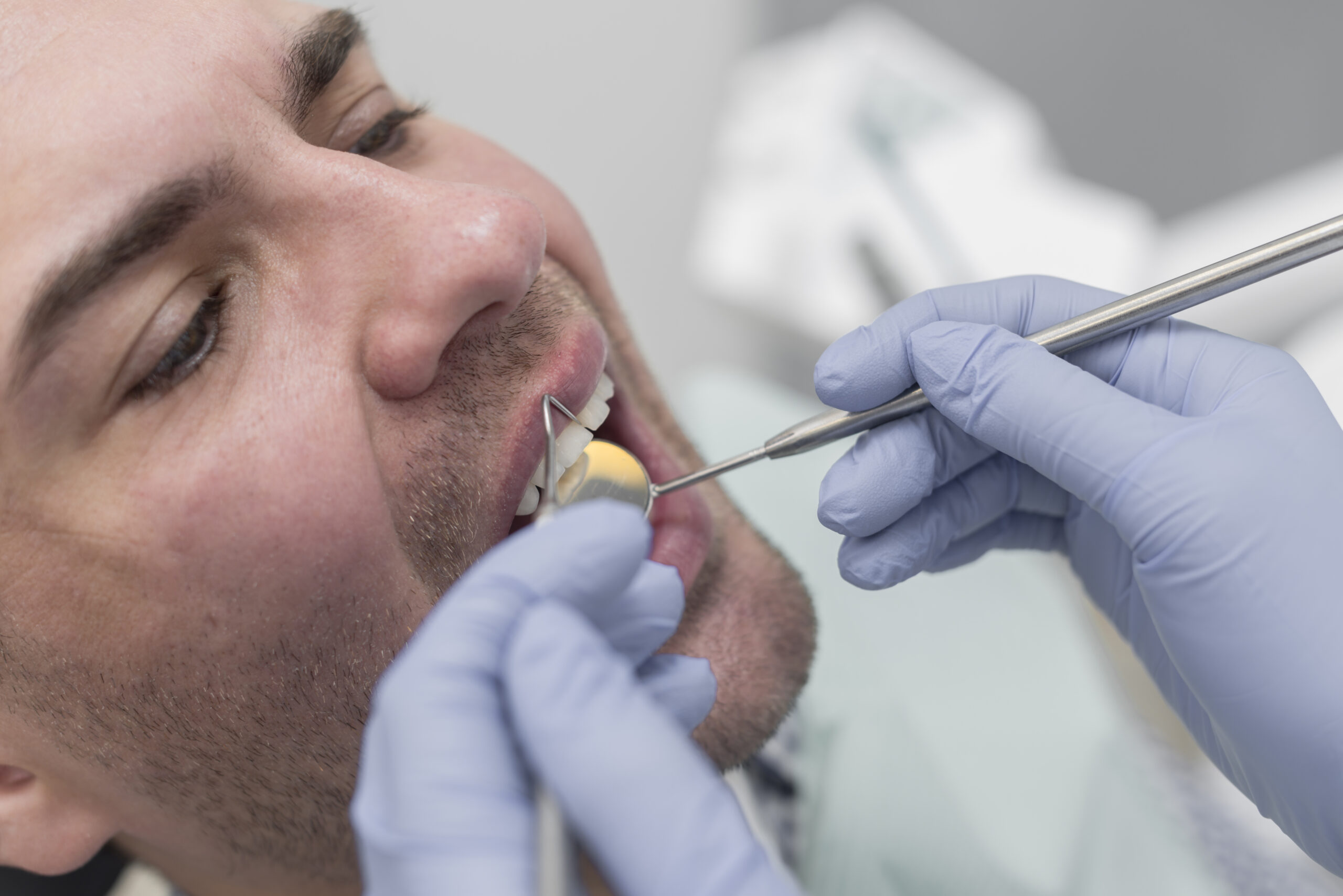 How Dental Sealants in The Colony Benefit Patients of All Ages