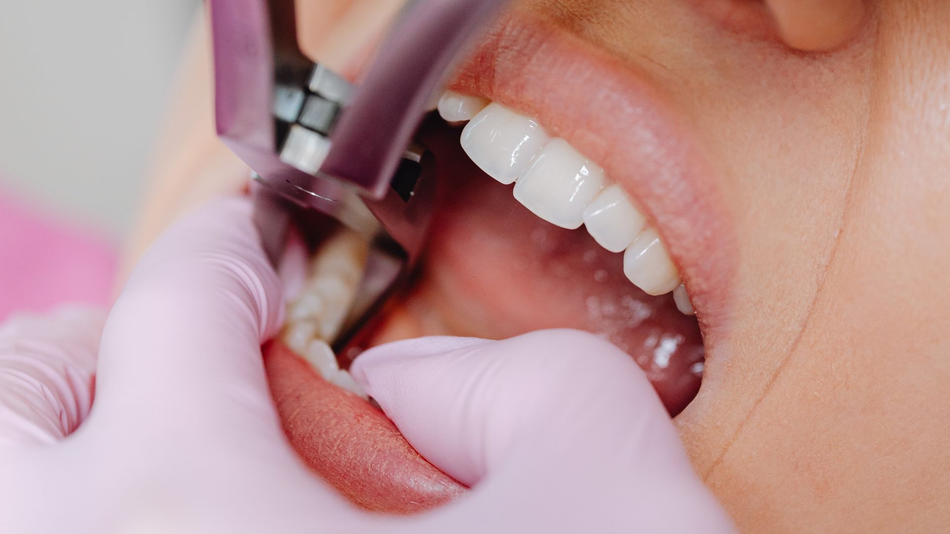 Why Choose a Cosmetic Dentist in Lewisville for Your Smile Makeover?