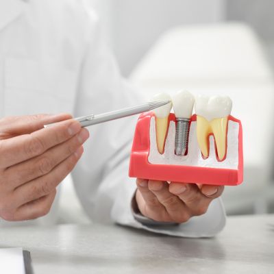 How Dental Implants Can Improve Your Oral Health Beyond Aesthetic Results